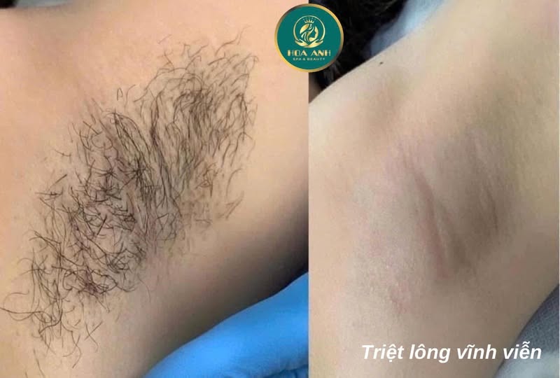 Trước và sau triệt lông nách tại Hoa Anh